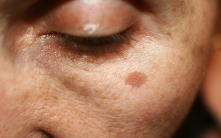 Sun Safety and Skin Cancer Prevention: What You Need to Know